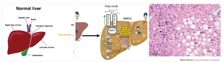 간세포 속 지방 직접 분해…국내 연구진, 지방간 ‘직접 제거’ 치료제 개발