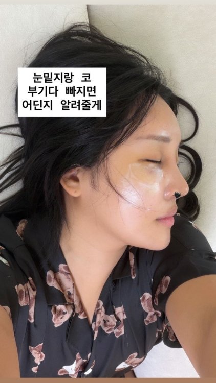 "부기 빠지면 병원 공개" 랄랄, 코 수술 후 자신감